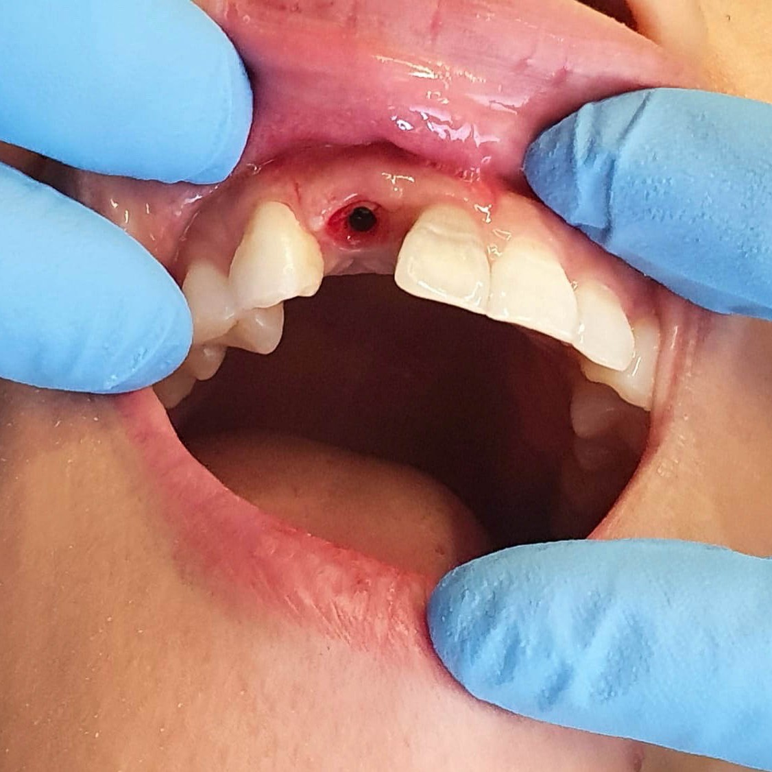 Zahnarzt in Königs Wusterhausen - Implantat-Zähne-Mund-Finger