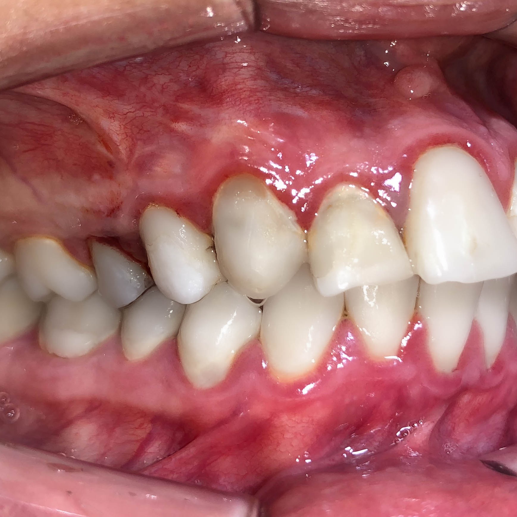 Zahnarzt in Königs Wusterhausen - Parodontitis-Zähne-Zahnfleischentzündung