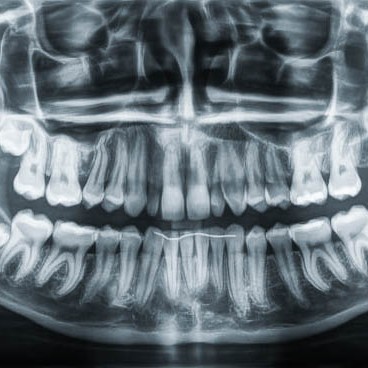 Zahnarzt in Königs Wusterhausen - Weisheitszähne-Röntgenbild