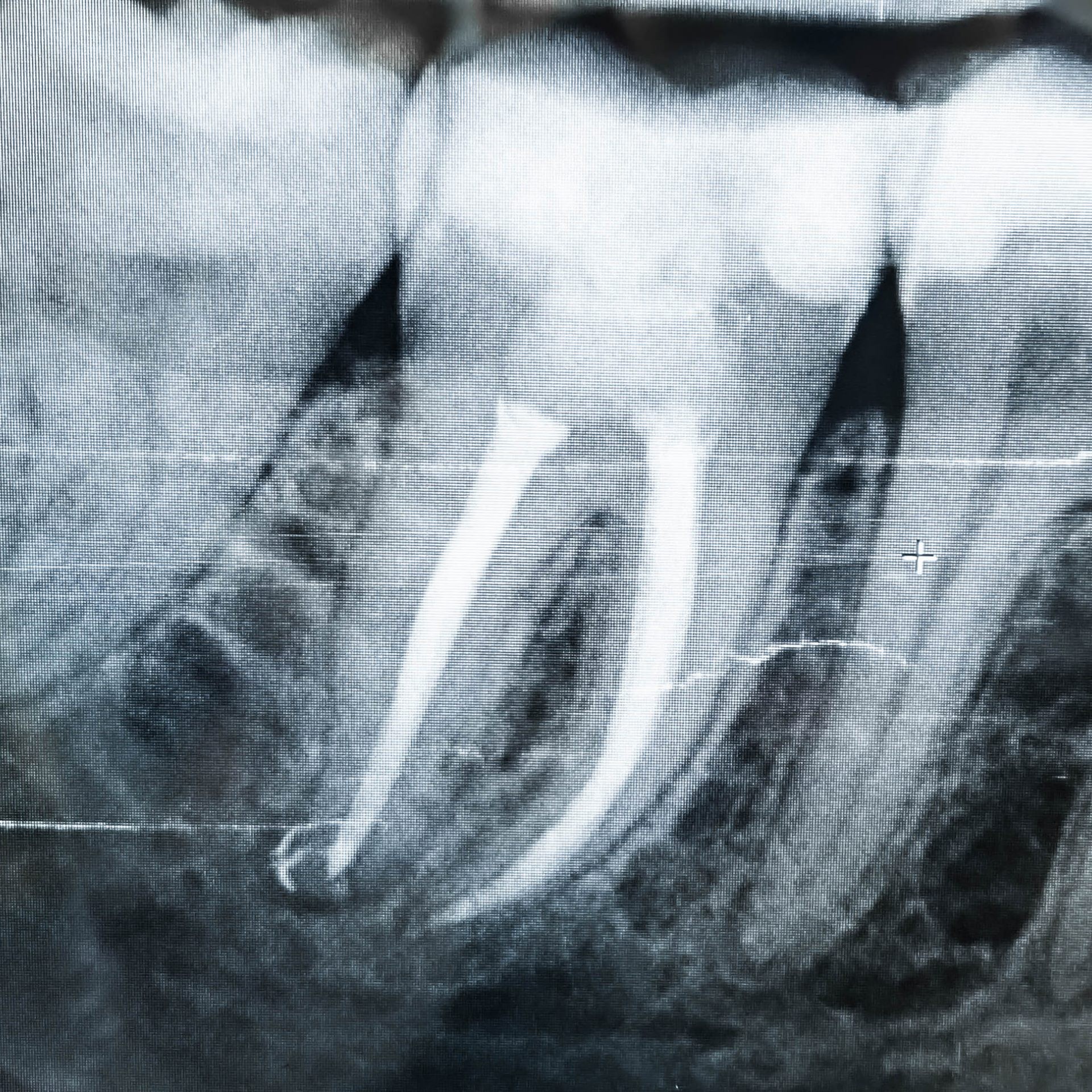 Zahnarzt in Königs Wusterhausen - Wurzelkanalbehandlung-Röntgenbild