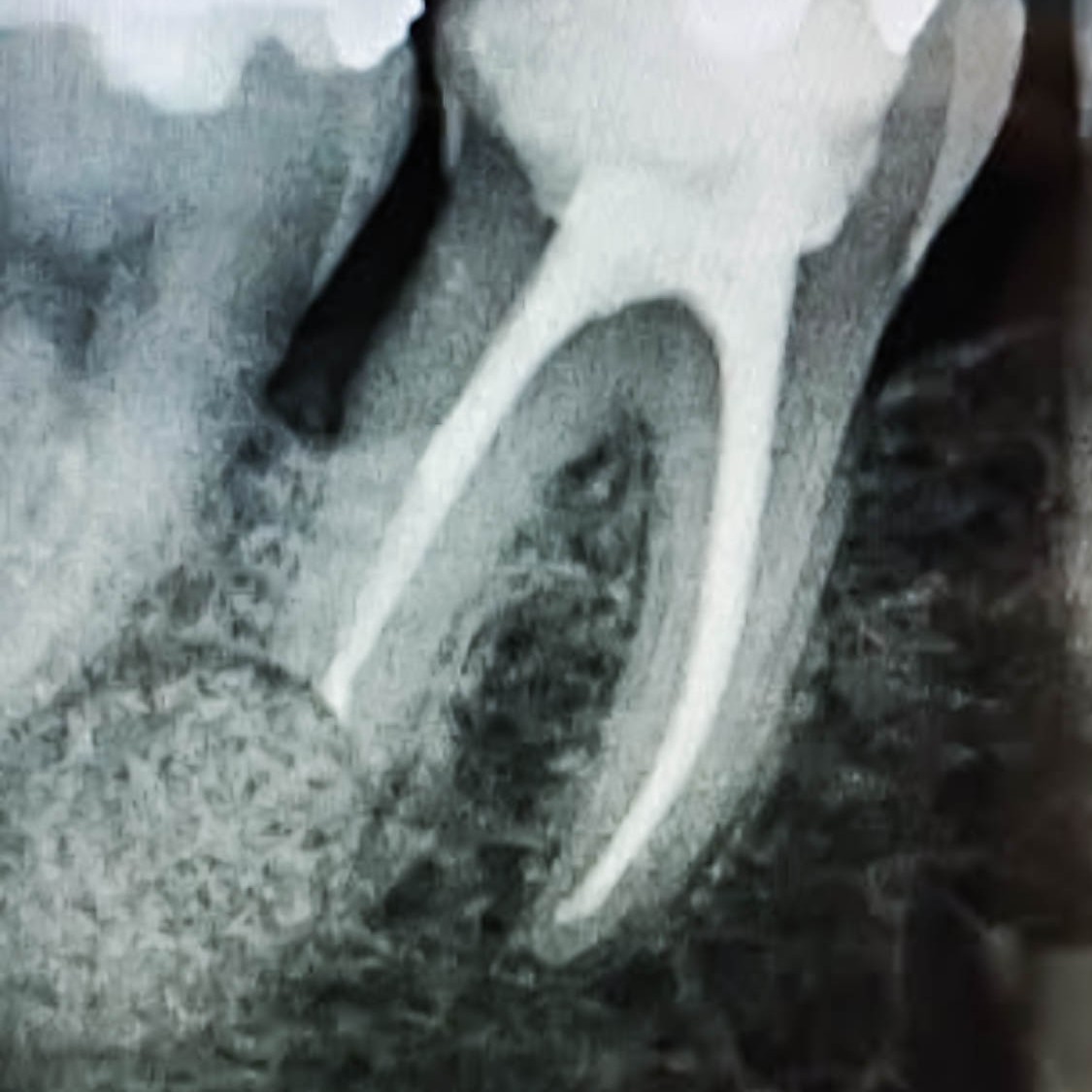 Zahnarzt in Königs Wusterhausen - Wurzelspitzenresektion-Röntgenbild